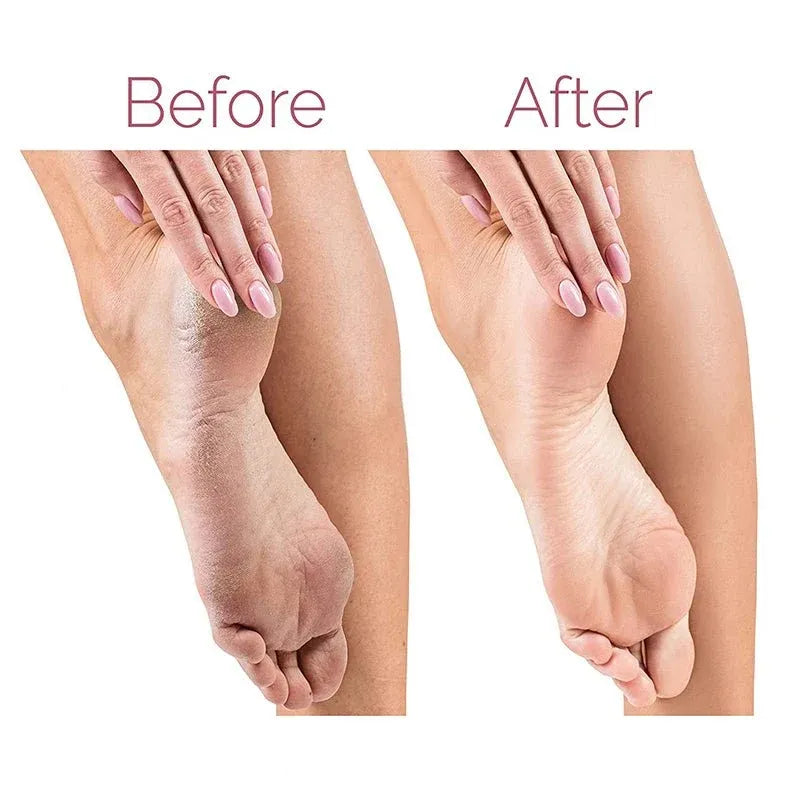 Foot-file promotional image comparing heel appearance before and after use